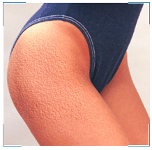 celulitis